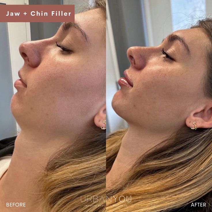 chin filler before and after photo