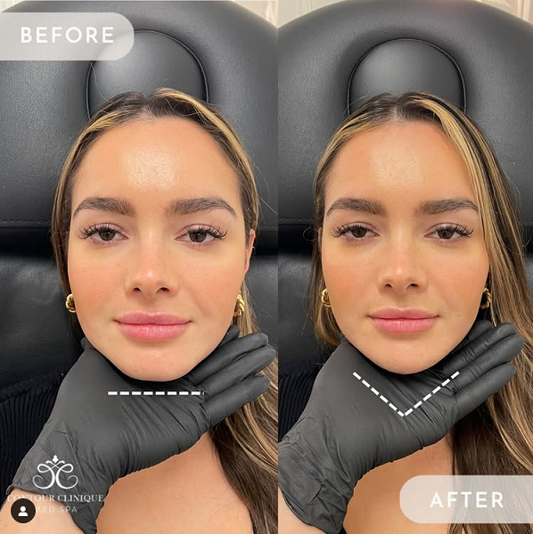 chin filler before and after instagram photo