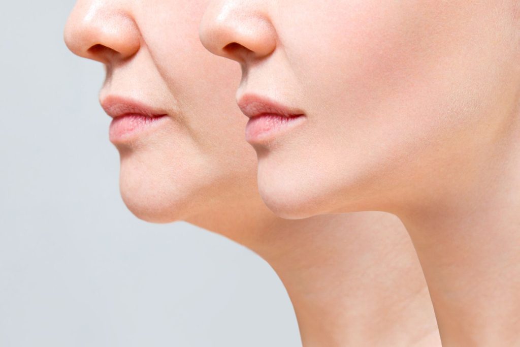 chin fillers gone wrong