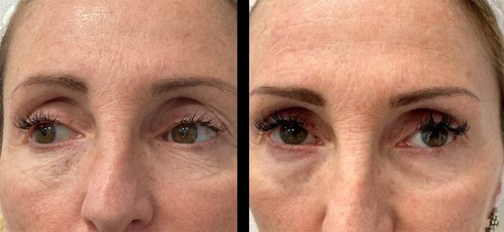nucleoill eyes before and after rejuvenation