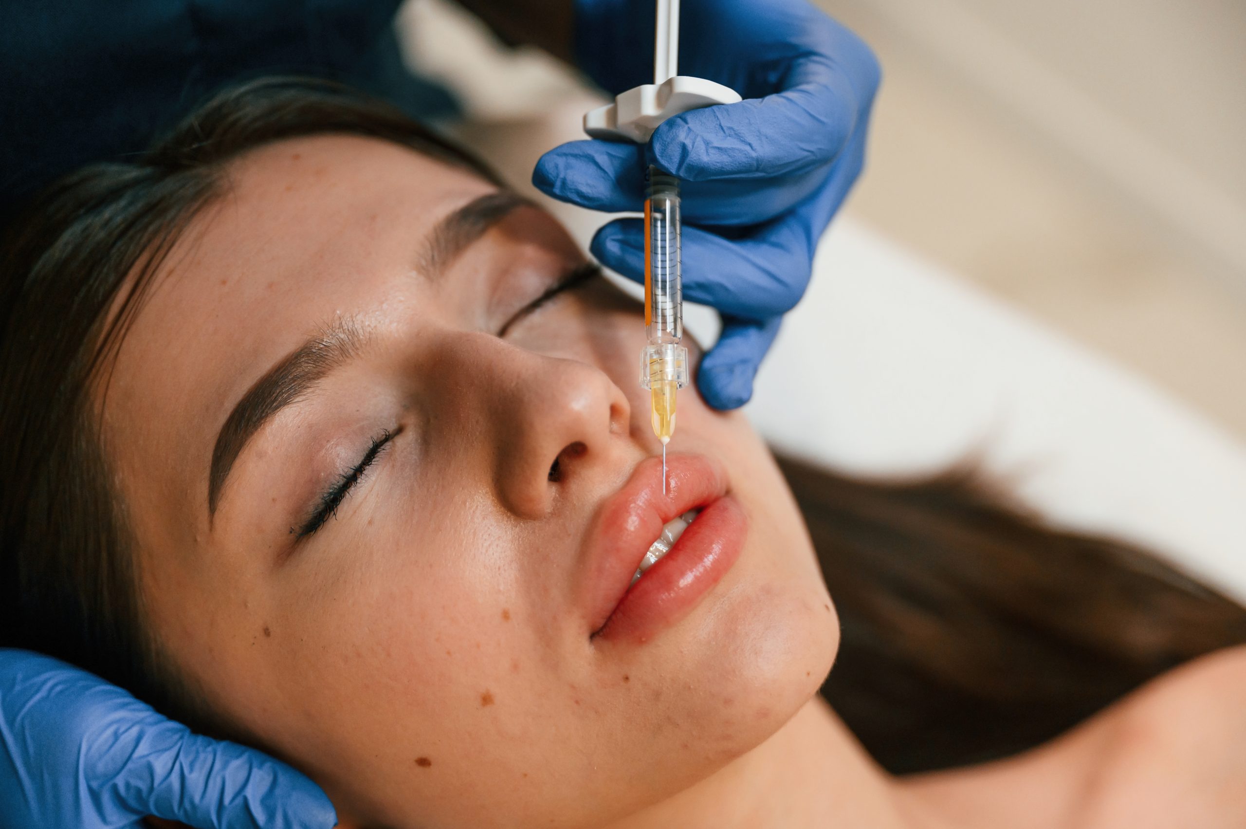 juvederm lip fillers
