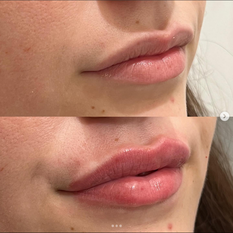 lip fillers before and after photo