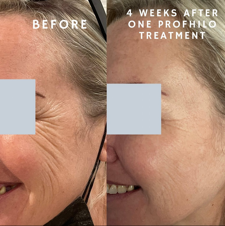 profhilo before and after results