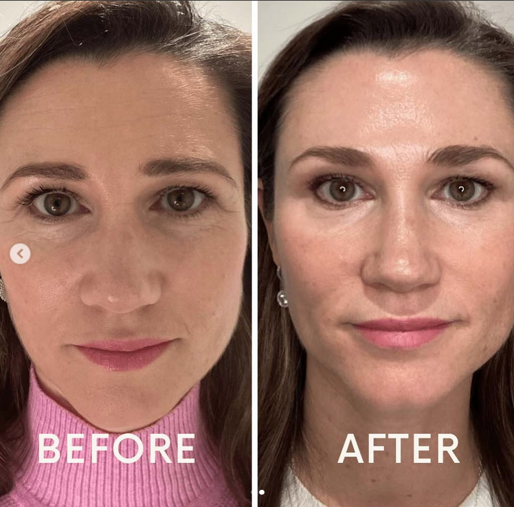 profhilo before and after photo