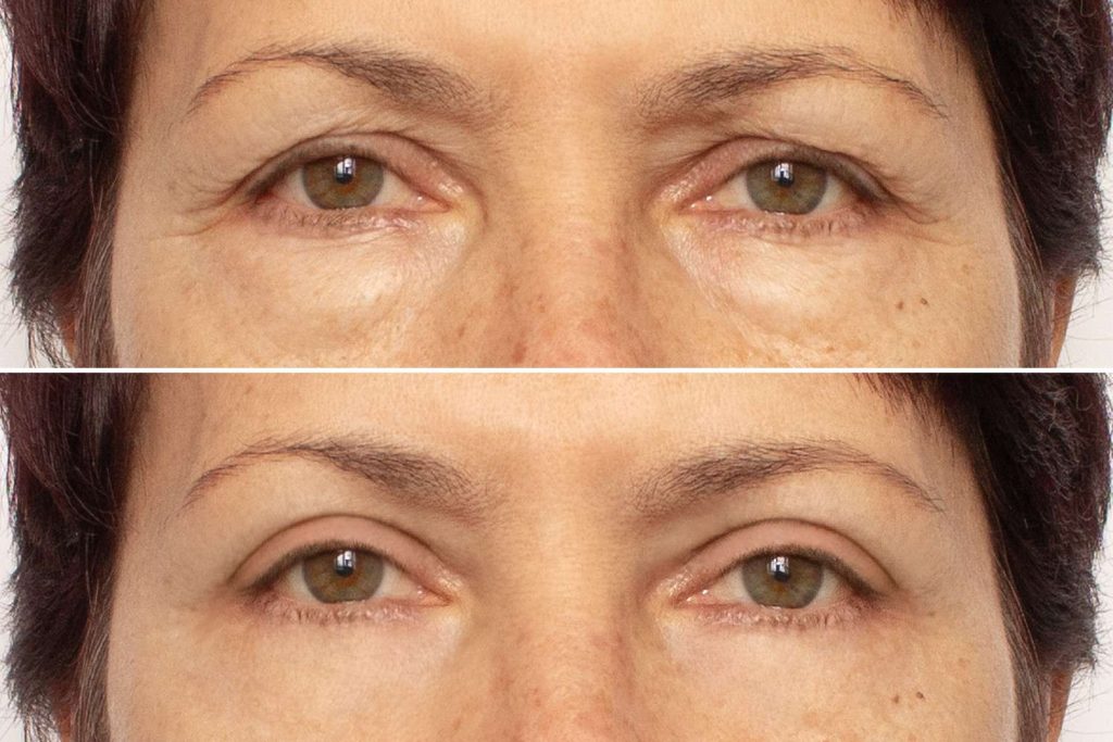 profhilo before and after eyes treatment
