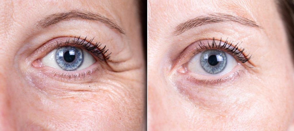 profhilo before and after eyes treatment
