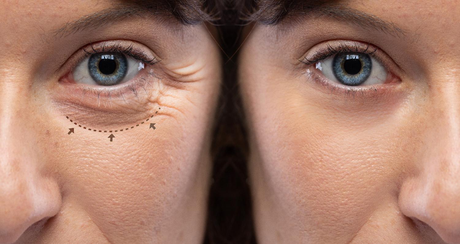profhilo before and after eyes in a woman