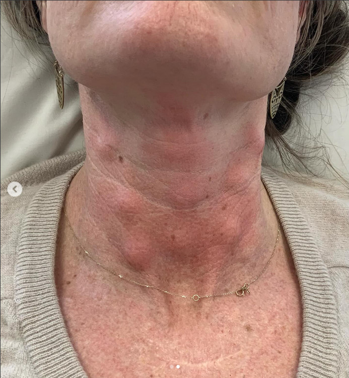 profhilo gone wrong on neck
