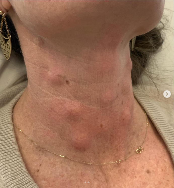 profhilo lumps on neck
