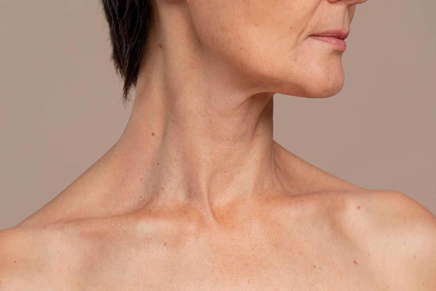 Profhilo neck before and after image of a woman