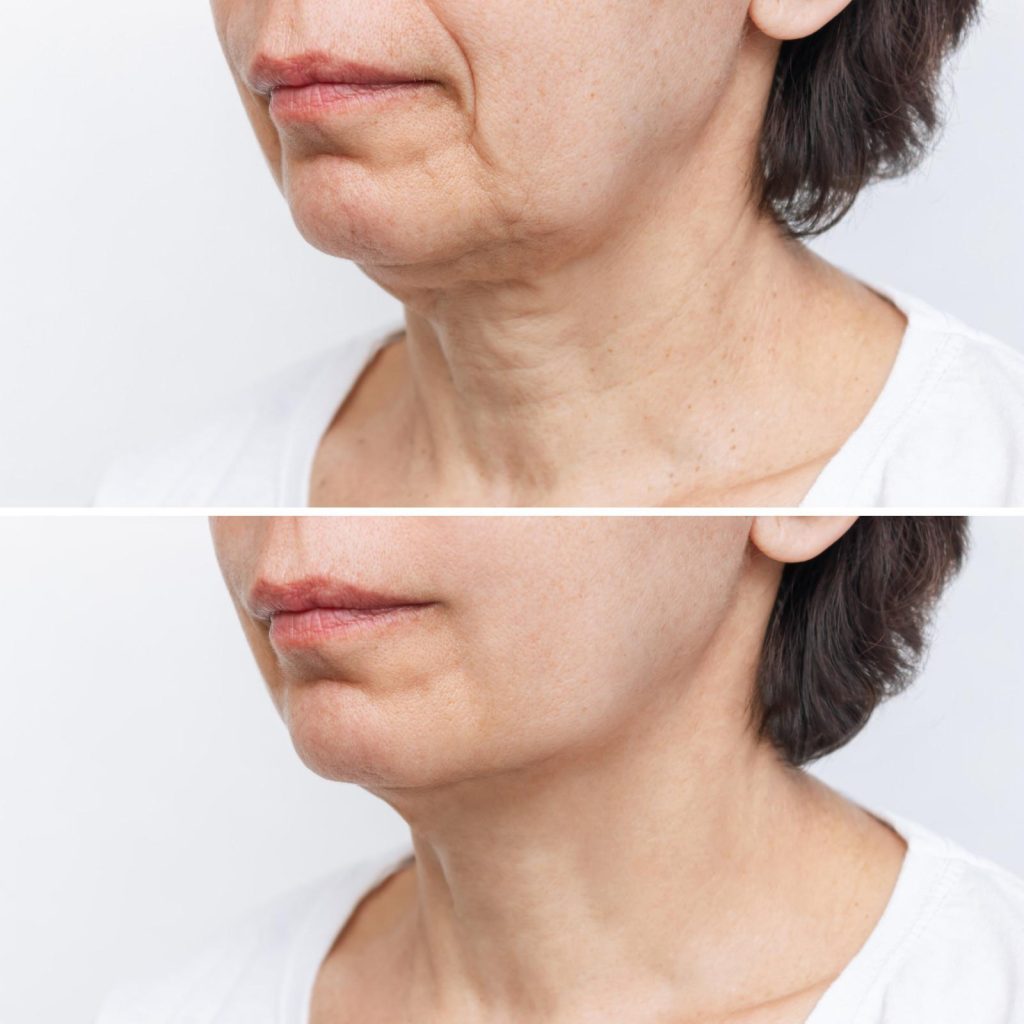Profhilo neck before and after on an older woman