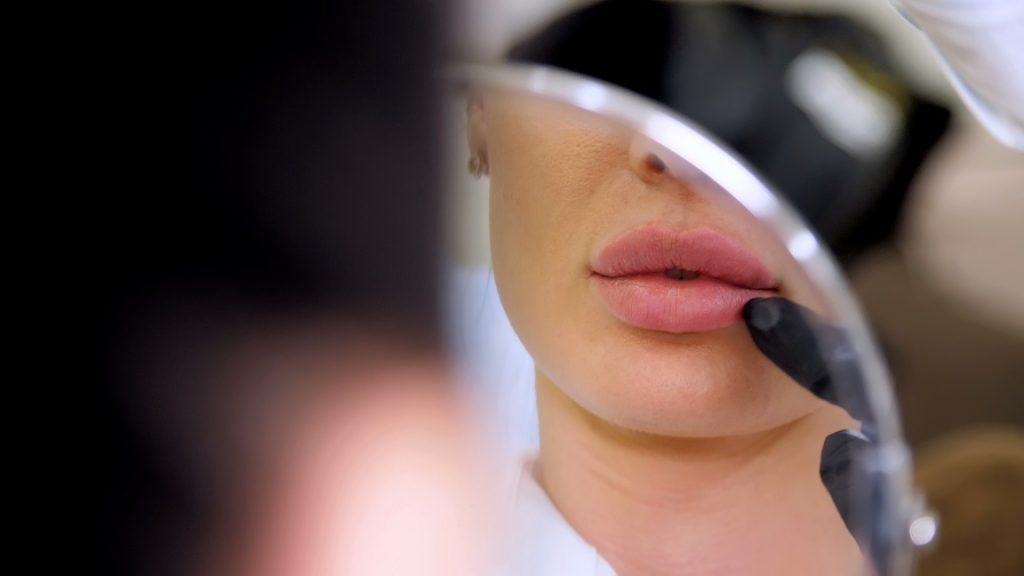 russian lip filler results