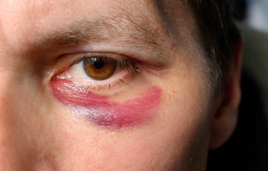 under eye profhilo gone wrong a bruise