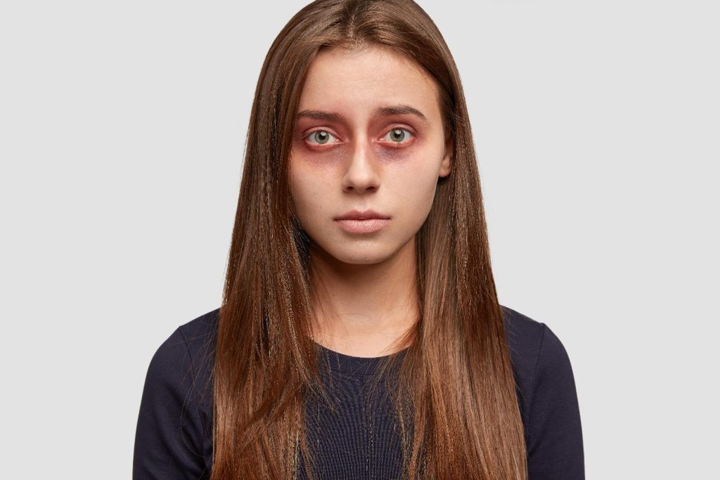 under eye profhilo gone wrong young woman