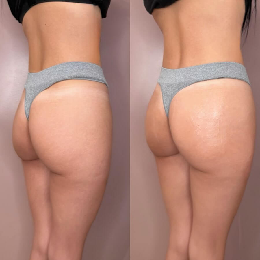 radiesse bbl before and after results