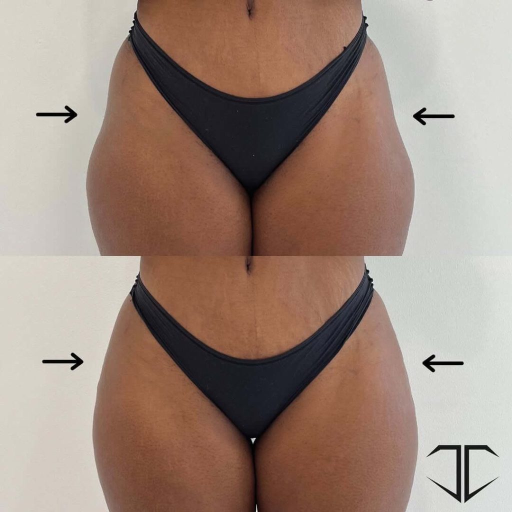 radiesse hip dip filler