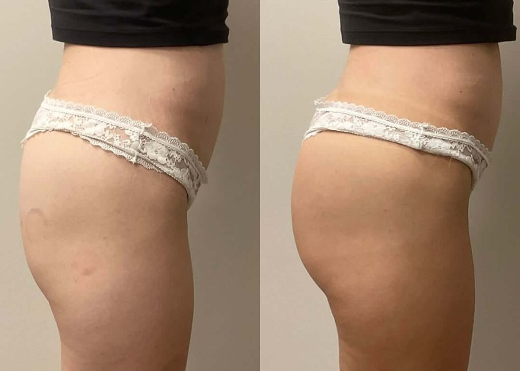 radiesse bbl female patient before and after