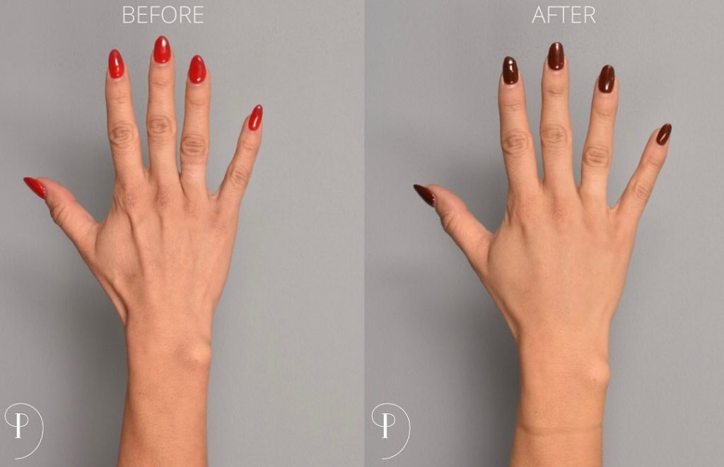 female patient hands after Radiesse filler