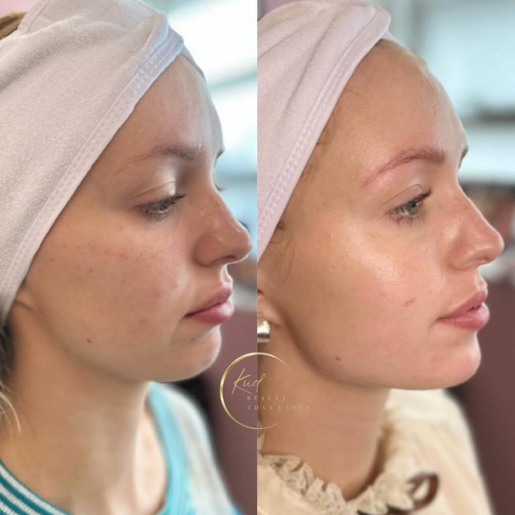 female patient before and after Radiesse jawline transformation