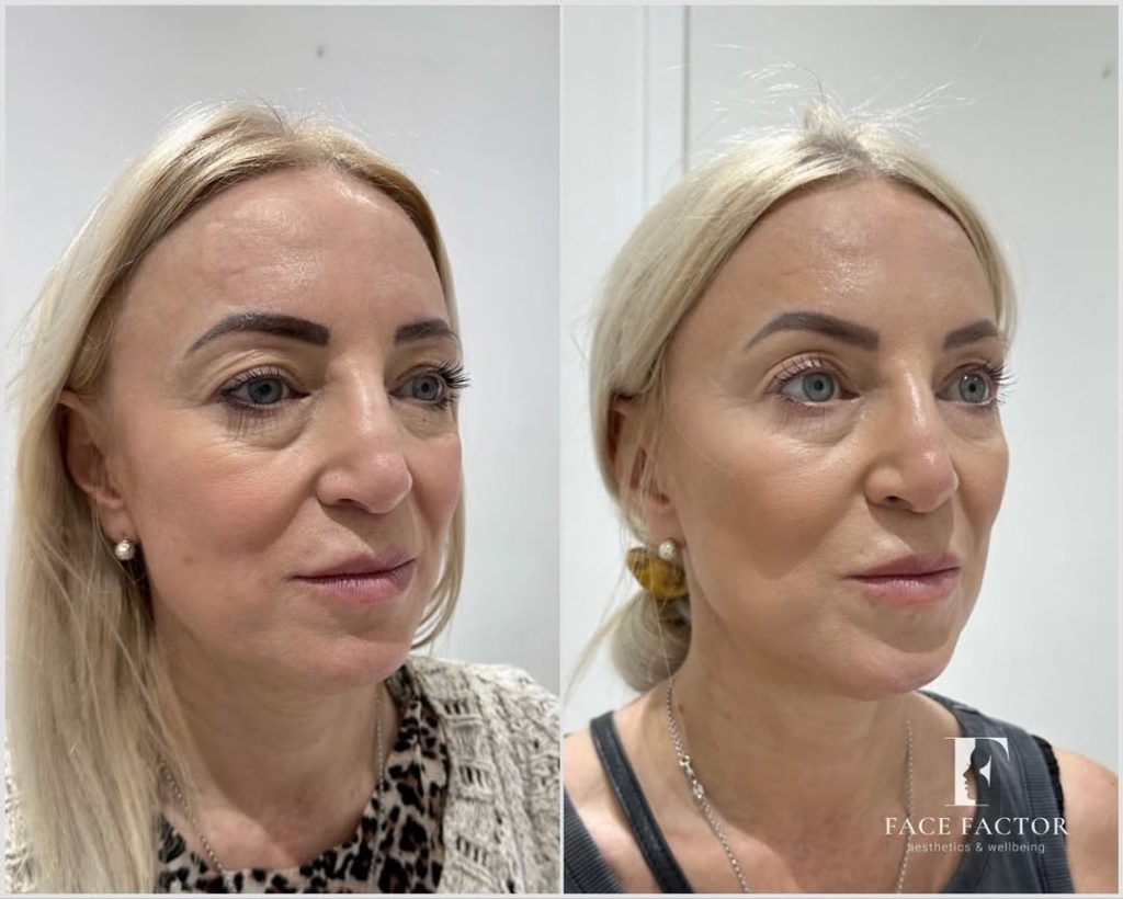 female patient before and after image following Radiesse treatment