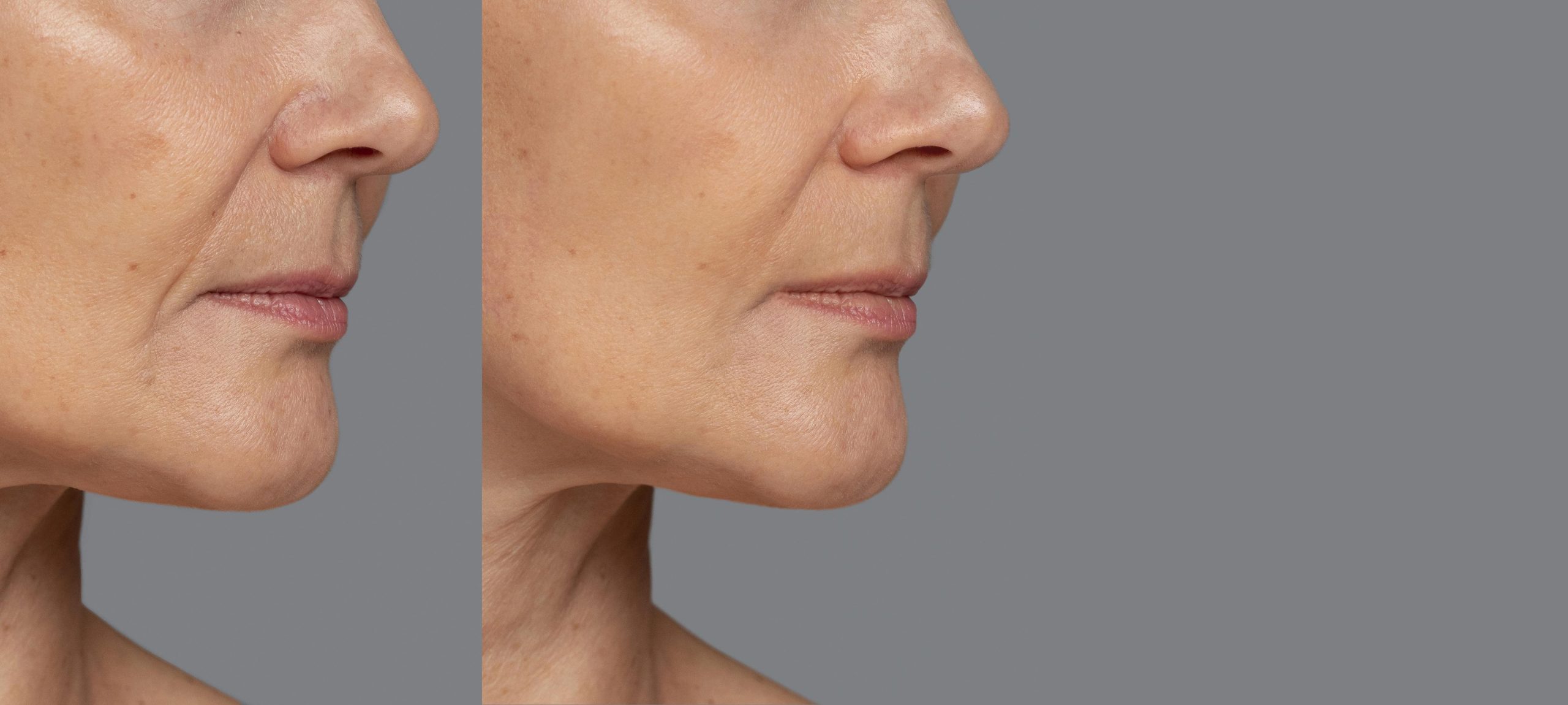 Radiesse filler before and after on marionette lines