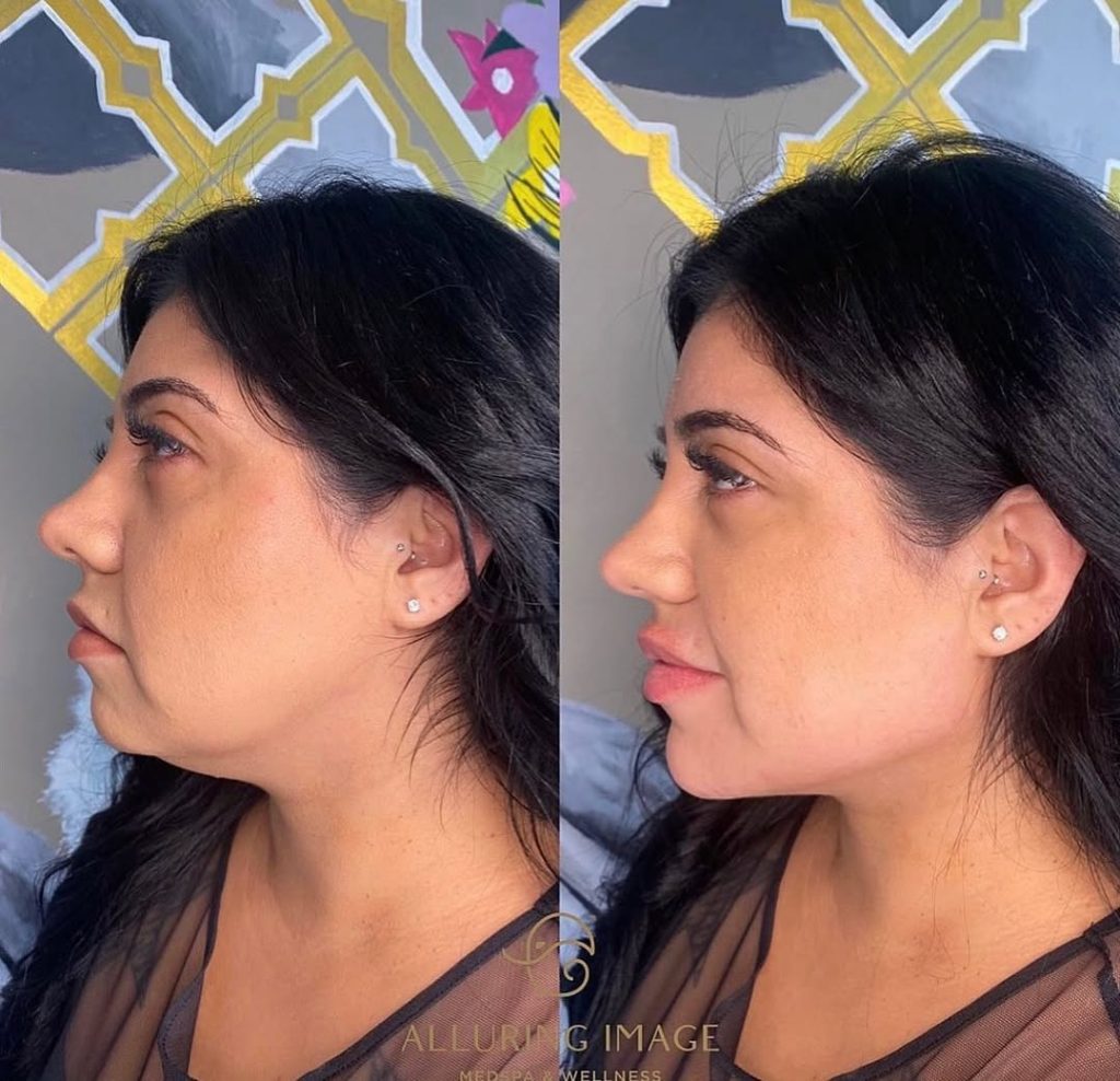 radiesse jaw before and after