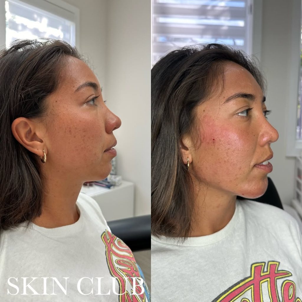 radiesse jaw before and after example