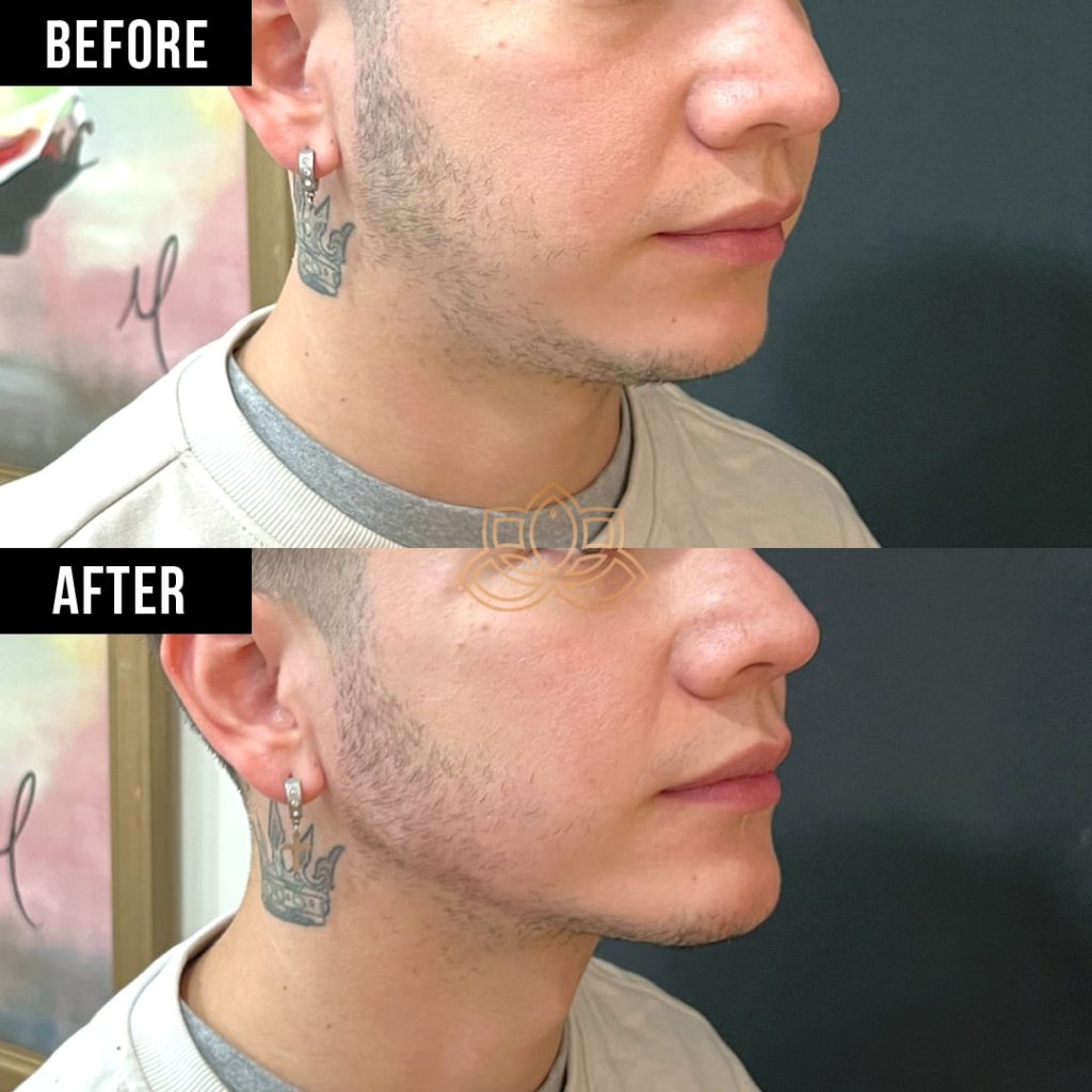 male patient before and after radiesse jawline filler
